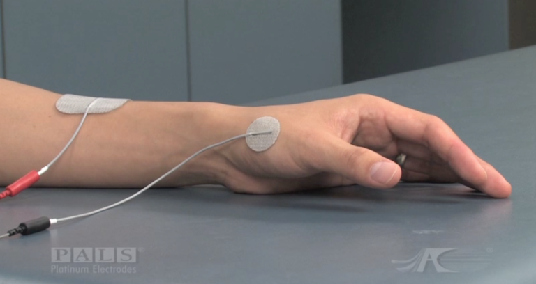 Electrode Placement Guide for Stroke Recovery: Upper & Lower Limb ...